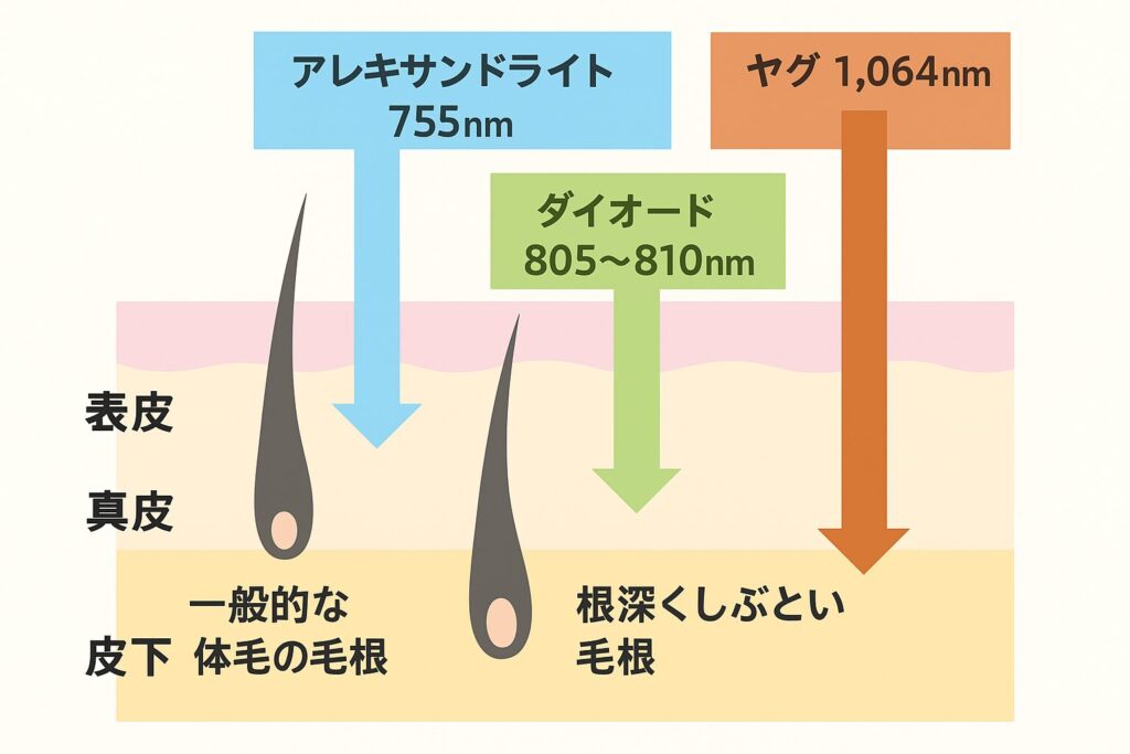 皮膚の断面図にレーザーの照射深さを示す図。アレキサンドライトレーザー（755nm）は真皮中層まで、ダイオードレーザー（805〜810nm）は真皮下層まで、ヤグレーザー（1064nm）は皮下脂肪まで到達する様子を示している
